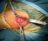 DAA No3 Retractor