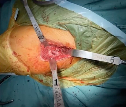 DAA No3 Retractor