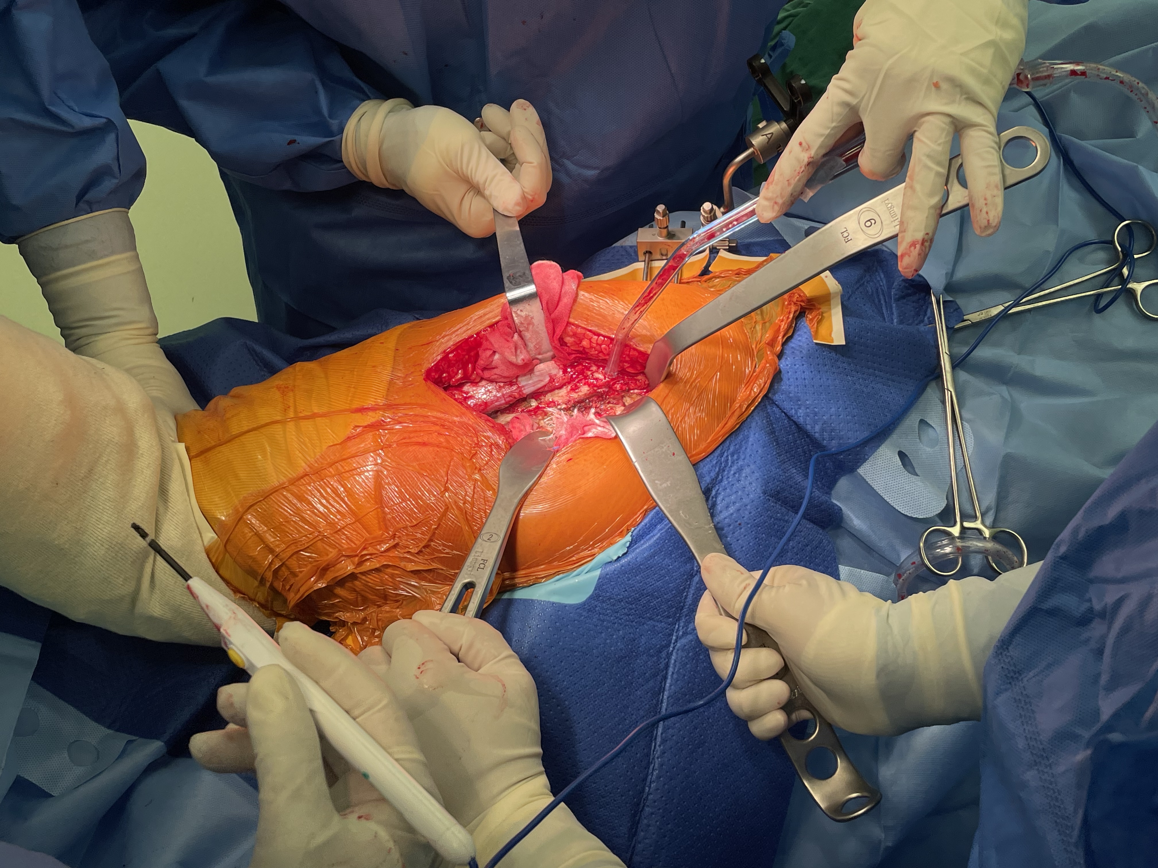 DAA Muscle Retractor